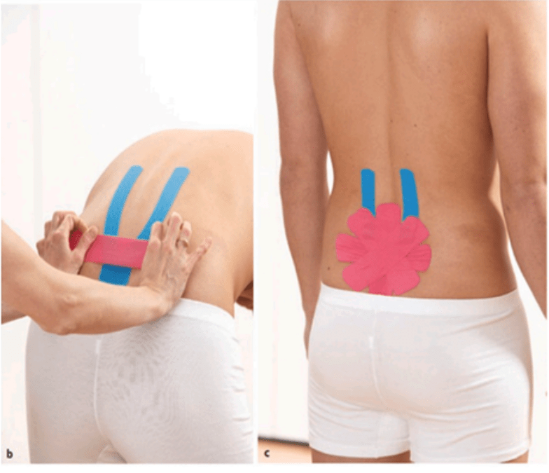 Adding kinesiology tape to your low back exercise regime may give you better improvements than exercise alone by Steve Stahl